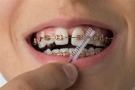 cuidarse los dientes con brackets metalicos|como limpiar brackets.